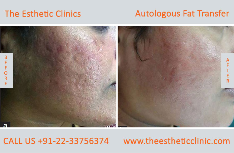 Autologous Fat Transfer, Fat Transfer Grafting, Lipofilling Fat Transfer Surgery before after photos (1)